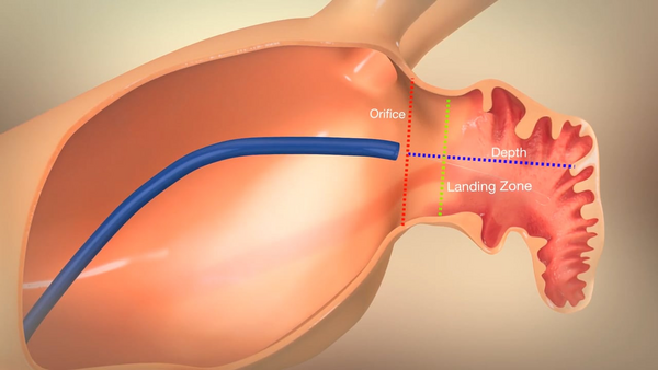 Animation zum Verschluss des linken Vorhofohrs Animation zum Verschluss des linken Vorhofohrs